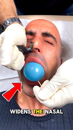Inflating Nostrils to Stop Snoring😳 When it comes to solving snoring problems, would you try inflating your nostrils like this? Balloon therapy gently expands the nasal passages to improve airflow and reduce nighttime snoring. It’s a unique, non-surgical approach that aims to make breathing easier while you sleep. credits: @ massage_arramesh / IG @ abbeymayradnidge / TT #SnoringSolution #BetterBreathing #SleepHealth #technology #tech | Life in Lines