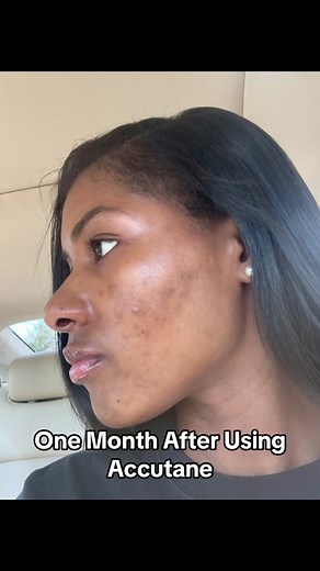 One-Month Accutane Update: Dealing with Dry Skin and Side Effects