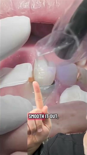 They said composite fillings look fake on front teeth… watch this