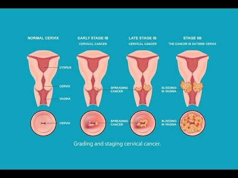 Treatment Options of invasive cervical carcinoma