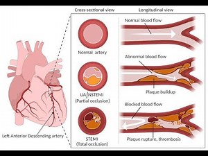 Pathophysiology Of Acute coronary Syndrome (ACS) ; Step to step to how it occured