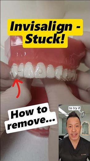 Invisalign Trays Stuck? Here’s What To Do! #dentallan #dentist #shorts