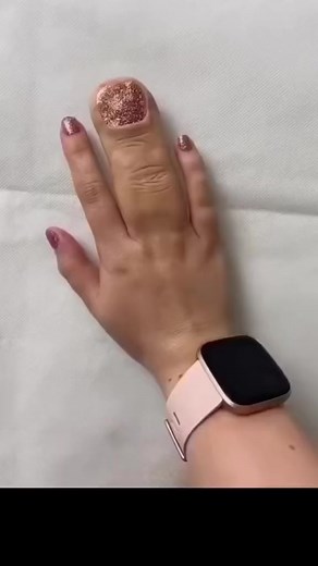 4.4K views · 29 reactions | Real or cap? #Macrodactyly #Syndactyly #Finger #Hand #MedicalStudent #Dr #Nurse #Cap #prosthetics | Nick Pappas, MD | Facebook