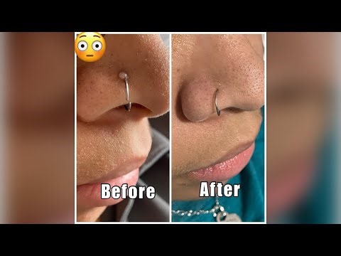 How To Treat a Piercing Bump and Know the Difference Between a Keloid Bump - BodyJ4You Aftercare