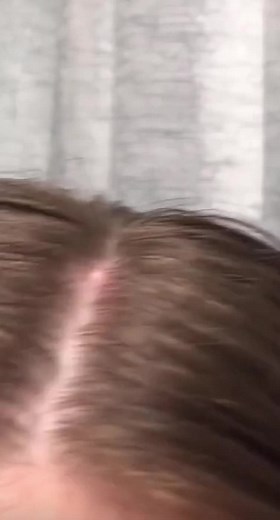 Exploding Blackheads and Pimples | ASMR Popping Videos