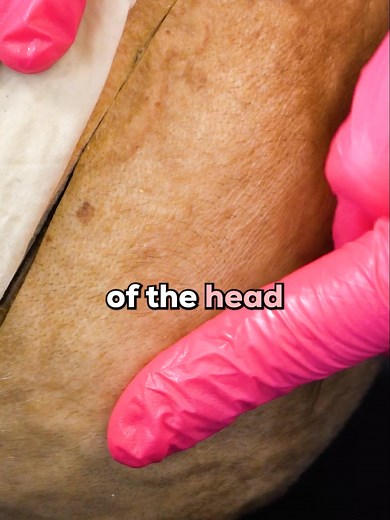 Brain Protection: Meninges, Dura Mater & Cerebrospinal Fluid