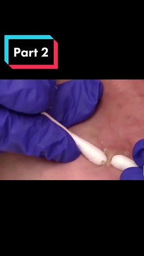 Pimple Popping Daily no TikTok