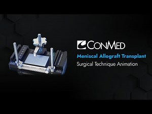 Meniscus Allograft Transplant - CONMED Animation