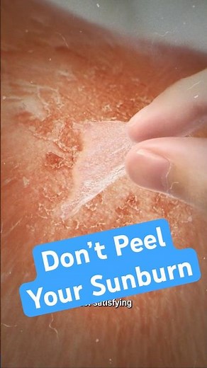 Stop Peeling That Sunburn