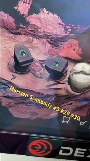 Scanbody impression using Dexis Scanner #3 #29 #30 #dentist #implantdentistry #dental #implants