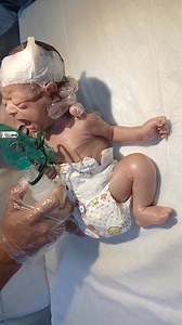 This case focuses on a newborn baby diagnosed with chest infection (bronchiolitis) requiring nebulization therapy for respiratory support. The nursing team carefully performs nebulization using prescribed medication, monitors SpO₂, respiratory rate, and chest movement, and ensures proper airway clearance. The management protocol includes humidified oxygen therapy, IV fluids, antibiotics (if indicated), and strict aseptic precautions. Continuous monitoring and gentle nursing care help stabilize b