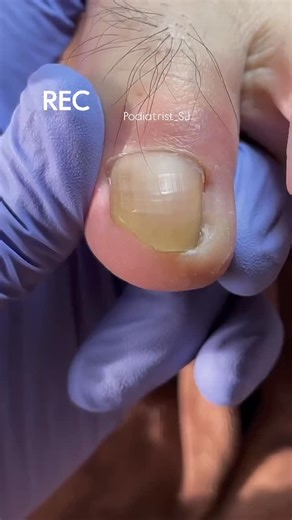 @podiatrist_sj on Instagram: "yellow, thick, and crumbly nails? 😬 that’s a classic sign of a fungal nail infection! 🦠 over time, fungus can spread deep under the nail, making it painful and hard to clean. but with the right treatment, those damaged nails can heal and grow back healthy 👣✨ don’t cover it — treat it. healthy nails start with proper care 💪 #fungalnailinfection #nailfungus #toenailtreatment #footcare #footdoctor #healthyfeet #podiatristtiktok #satisfyingvideo #nailrestoration #be