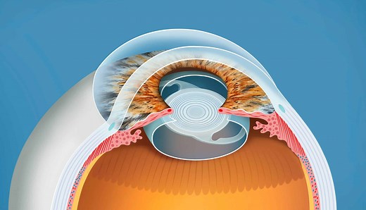 Premium IOLs | Northwest Eye Surgeons