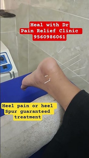 Heel Spur treatment with dry needle therapy or acupuncture therapy #healwithdr #heelspur
