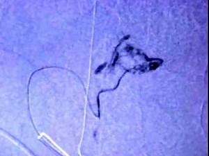 Tumor_Embolization_01-27-12.mp4