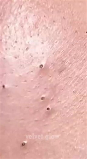 Acne Face Map Explained 😳 What Your Breakouts Mean