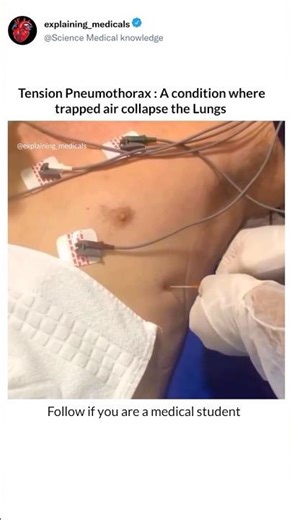 Tension Pneumothorax: A condition where trapped air collapse the Lungs 🫁 #pneumothorax