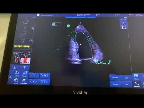 How to measure strain on the GE Vivid echo machines