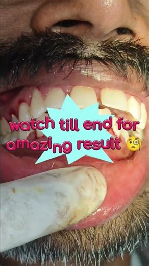 Deep teeth cleaning: Save your gums, boost health!#Shorts, #DentalCleaning, #OralHealth #youtube
