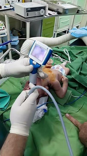 Newborn intubation using UE Miller 0 blade