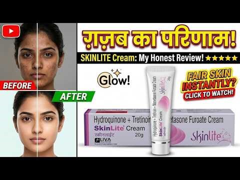 Skinlite Cream Use Dose Side Effects Benefits In Hindi
