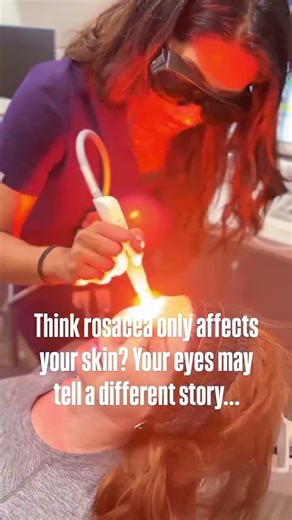 👀 Did you know rosacea can affect the eyes too? This is called Ocular Rosacea 🔴 Symptoms may