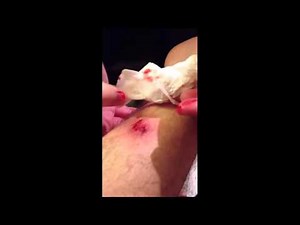 Popping Cyst 2016 Compilation by Dr Mike