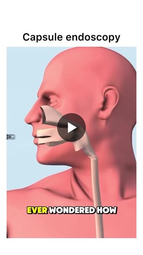 Capsule endoscopy: A non-invasive procedure for the small intestine | Dr S ATHEENA MILAGI PANDIAN B.E. M.E.. P.hD Thailand posted on the topic | LinkedIn