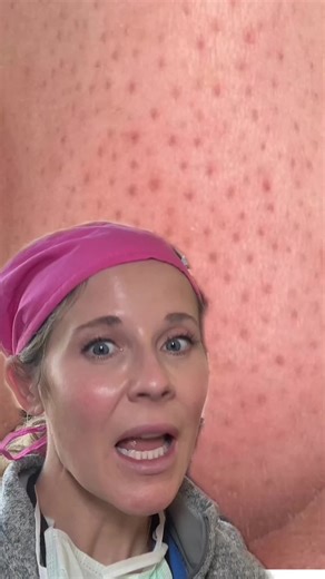 Dr. Abigail Waldman, MD FAAD on Instagram: "Black dots on the nose? Sebaceous filaments and how to make them less obvious, from a dermatologist. Follow if you have obvious sebaceous filaments #sebaceousfilament #acne #skincare #skin #dermatologist #salicylicacid"