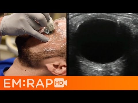Ultrasound of Retinal vs Vitreous Detachment