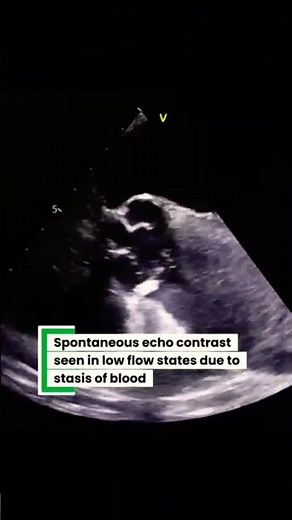 Aortic dissection type A