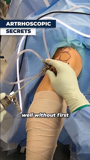 Big Secret To Successful Joint Arthroscopic Surgery⁉️