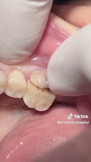 Lower Molar Tooth Fracture and Root Canal Treatment