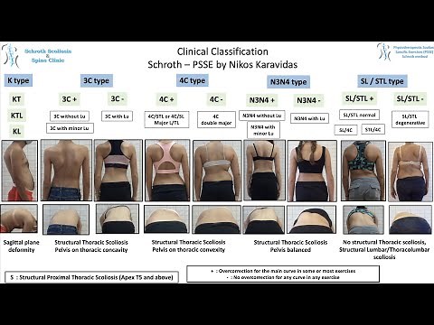 PSSE - Schroth method by Nikos Karavidas, Schroth Scoliosis & Spine Clinic