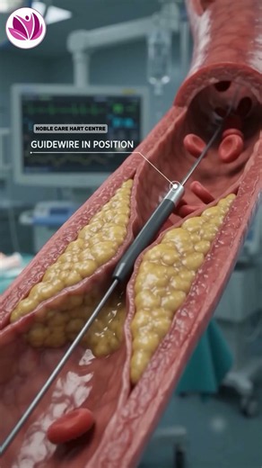 How Is a Stent Placed in a Blocked Heart Artery? | Angioplasty Explained