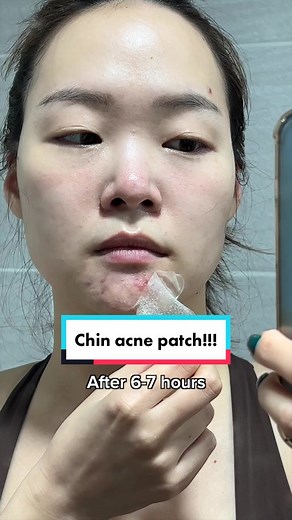 Mighty Patch Chin: Say Goodbye to Chin Acne