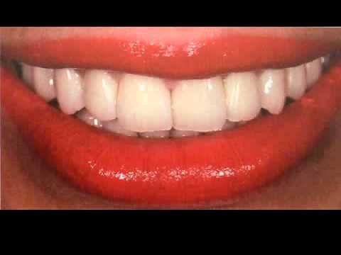 Tooth Color Selection for dentures