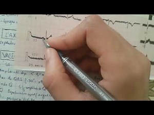 interpretation d'ecg pour les nuls