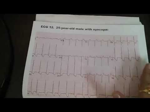 ECG abnormal electrocardiogram EKG www.drbenzur.com cardiology cardiologist doctor