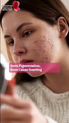 Can Popping Pimples Cause Acne Scars? | Acne Scars & Pigmentation Risks | Dermcos Skincare #shorts