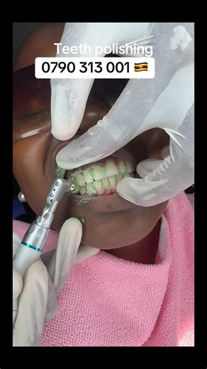 Teeth Cleaning and Polishing for a Fresh Smile