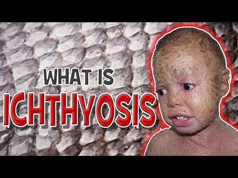 What is Ichthyosis - Cause, Symptoms & Treatment