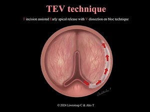 En bloc HoLEP of a 182cc prostate using the TEV technique