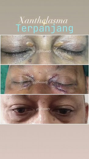 Pengertian dan Penanganan Xanthelasma