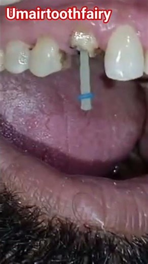 Composite and post core buildup#dental #shorts #viral #umairazeem @Umairazeem8553