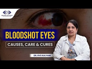 Bloodshot Eyes Explained: Causes, Treatment & When to Worry | Dr. Kalyani | Centre For Sight
