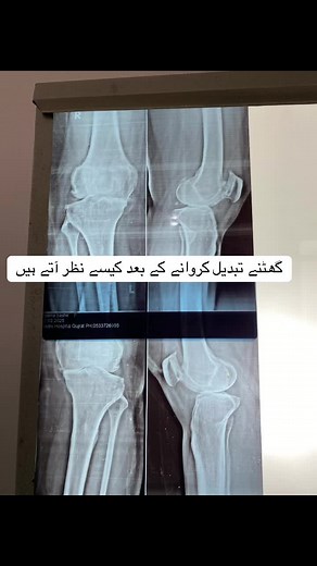 Before after TKR #tkr #kneephysiotherapy #tkrrehab #artheritis