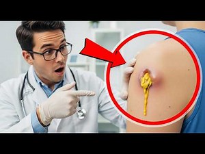 The Shocking Truth About Cyst Removal vs DRAINAGE