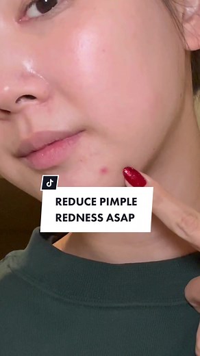 Quickly Reduce Pimple Redness in 5 Minutes