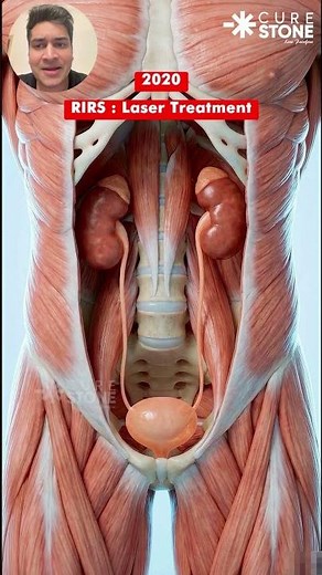 The Terrifying Evolution of Kidney Stone Surgery (1920 to 2050) 🤯 | RIRS Laser Treatment